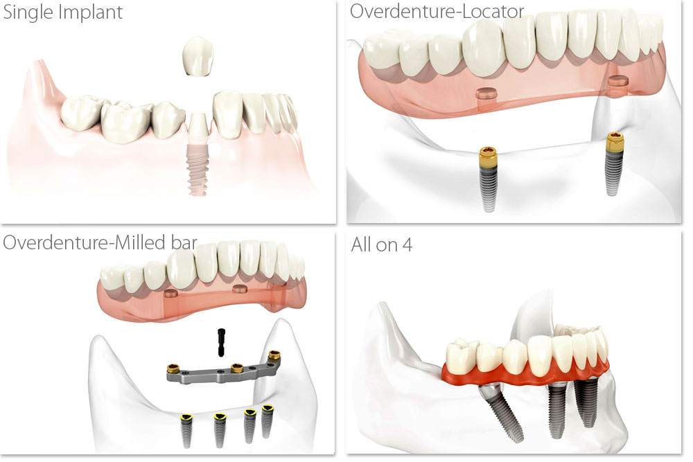 Single Implant, Overdenture-Locator, Overdenture-Milled bar, All on 4