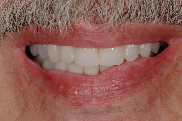 Teeth after whitening