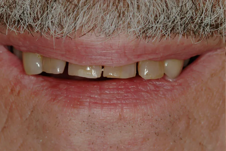 Teeth before whitening