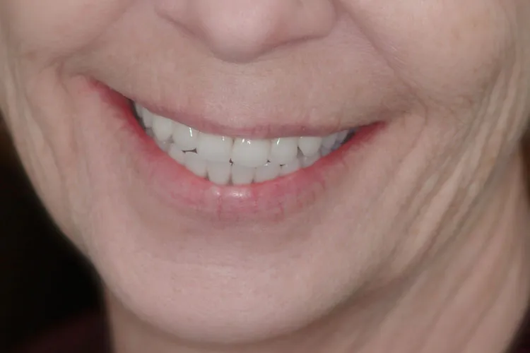 Complete dentures