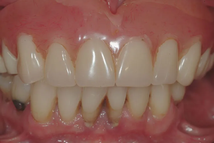 Complete dentures