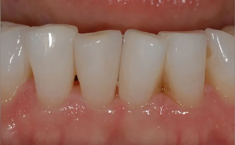 Aligned teeth