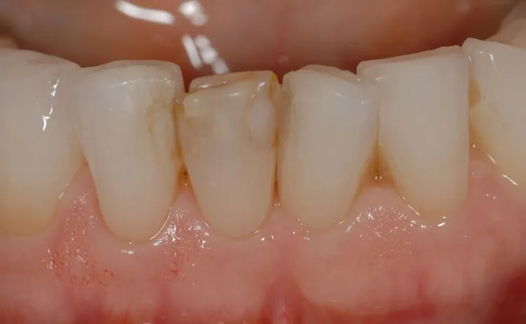 Misaligned teeth