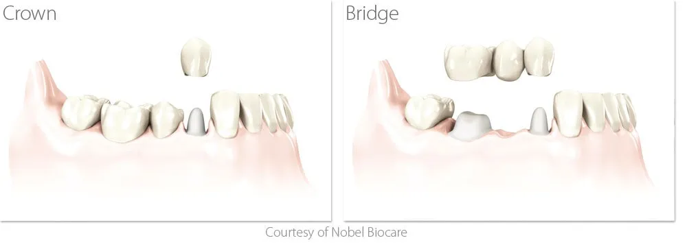 Animation of dental bridge