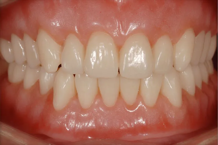 Complete denture