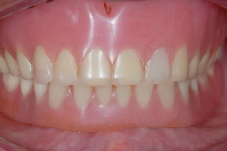 Complete denture