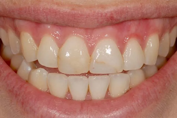 Esthetic Crowns Before
