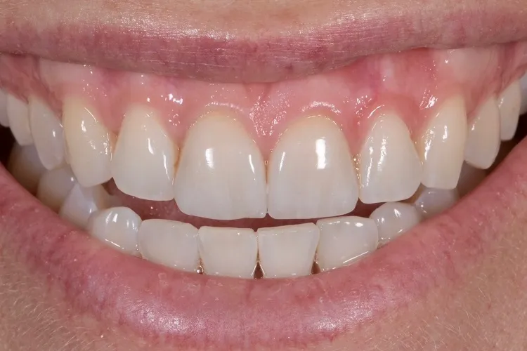 Esthetic Crowns After