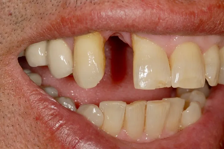 Esthetic Crowns Before