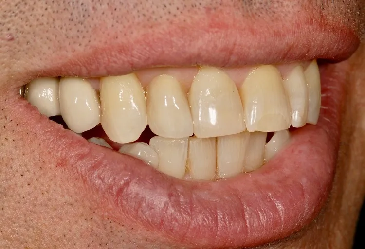 Esthetic Crowns After