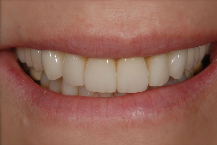 Teeth after recomposition