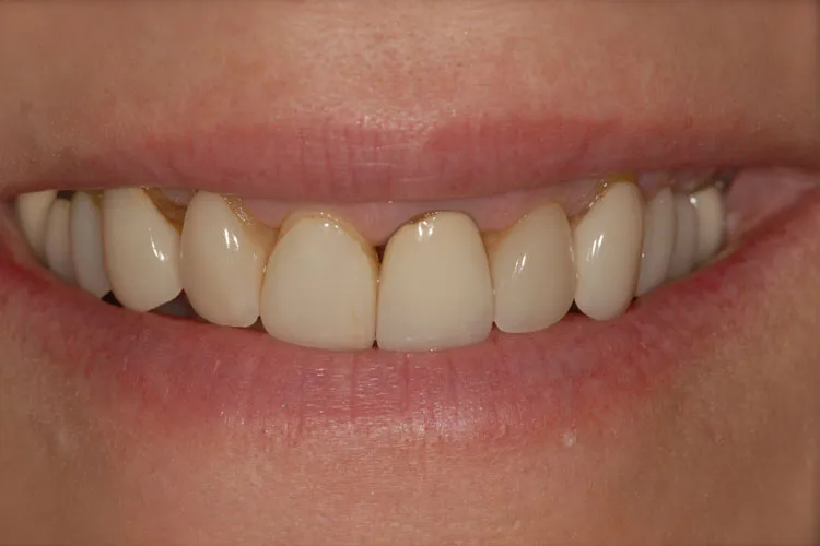 Before recomposition teeth