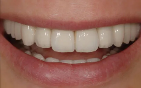After whitening teeth