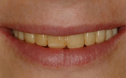 Stained teeth