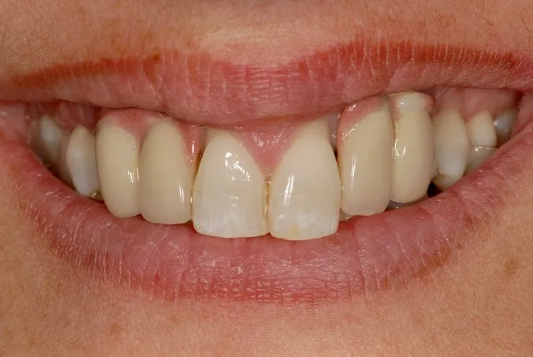 Implant Crown Before