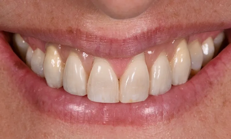 Implant Crown After