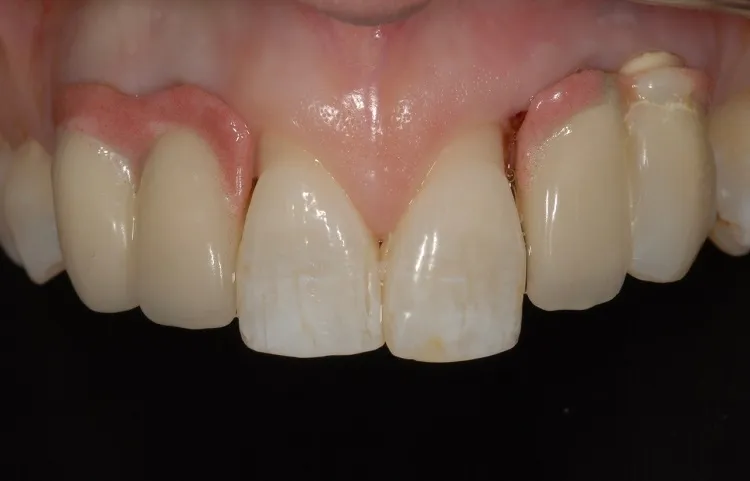 Implant Crown Before
