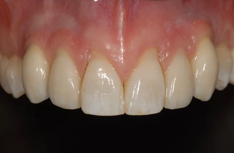 Implant Crown After