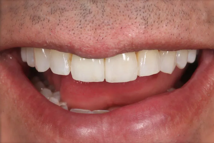 Filling of teeth
