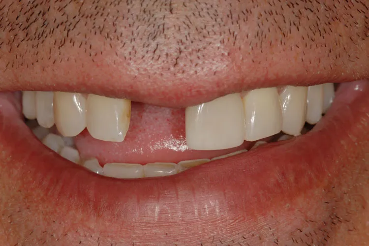 Hole in dentures