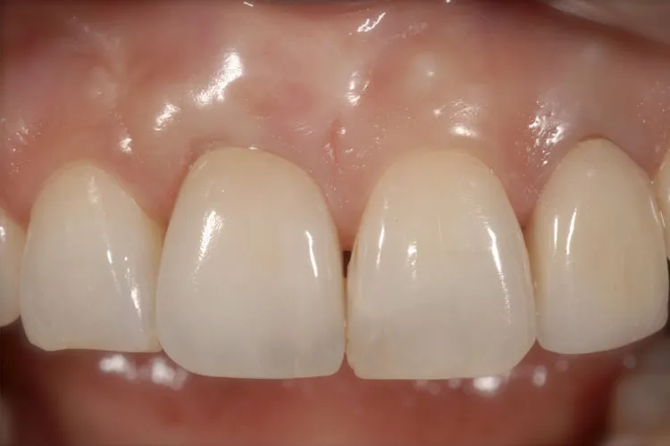 Filling of teeth in denture