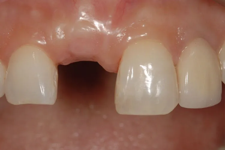 Hole in dentures