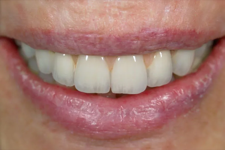 Complete dentures