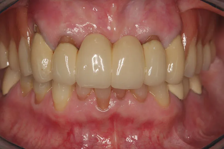 Complete dentures