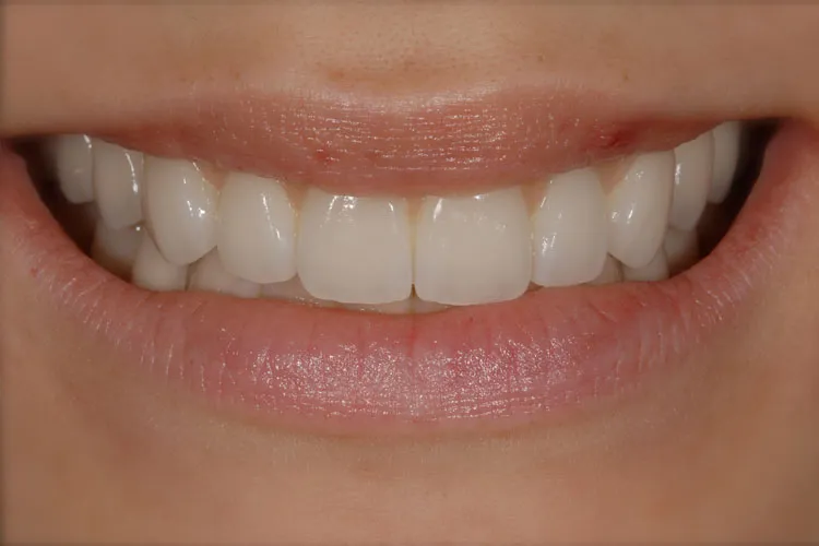 Complete denture