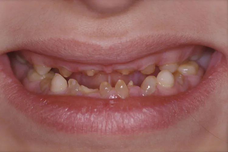 Teeth before dental procedure