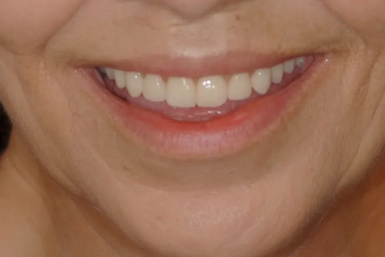 After teeth alignment