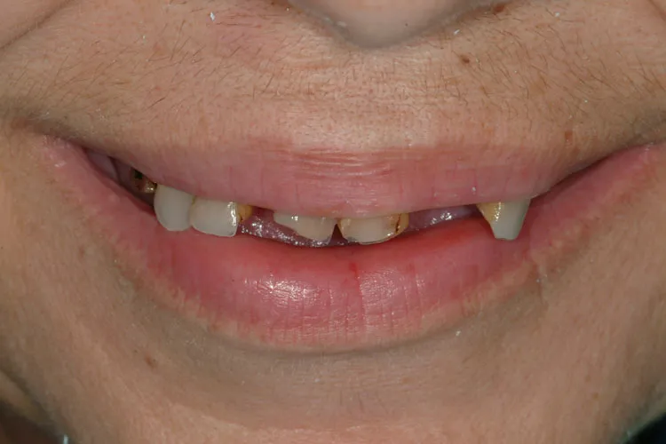 Disaligned teeth