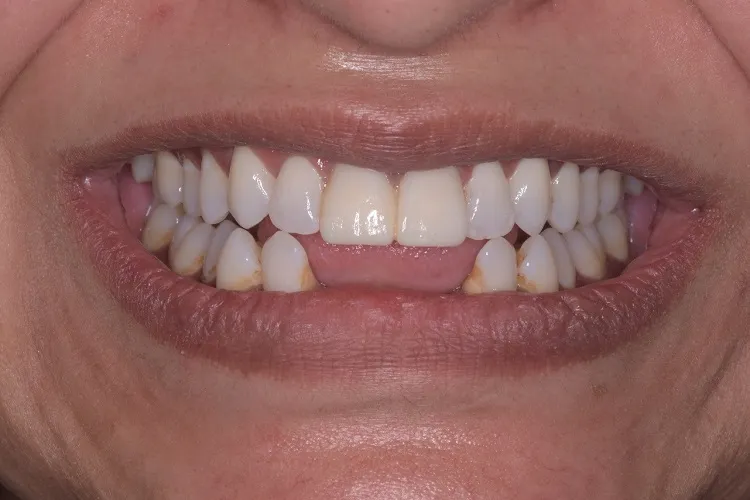 Implant Crown Before