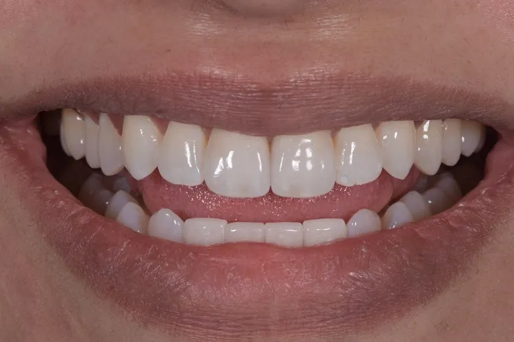 Implant Crown After