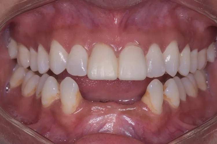Implant Crown Before