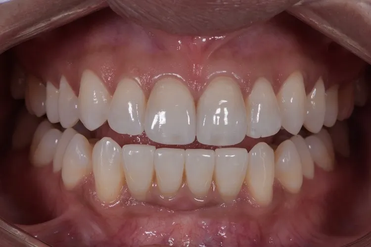Implant Crown After