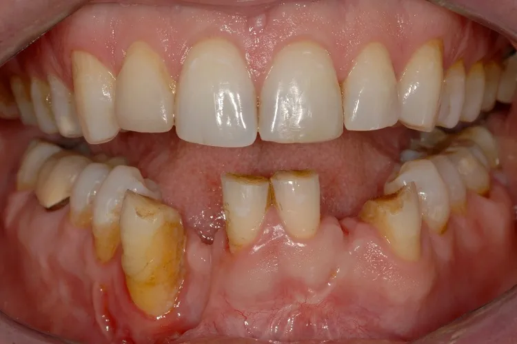 Implant Crown Before