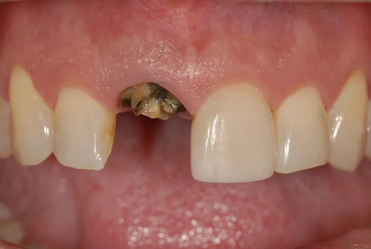 Implant Crown Before