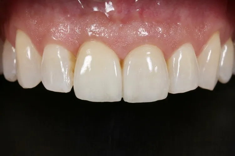Implant Crown After
