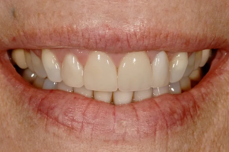 Before Porcelain Veneers