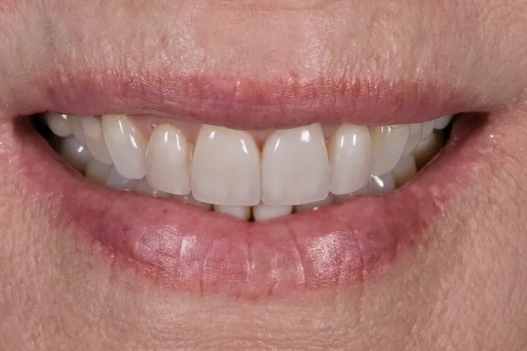 After Porcelain Veneers
