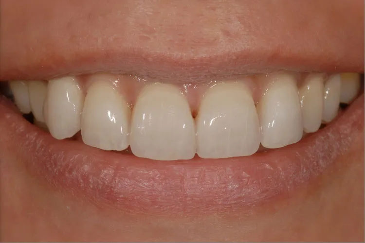 Dentures after whitening