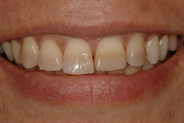 Stained teeth
