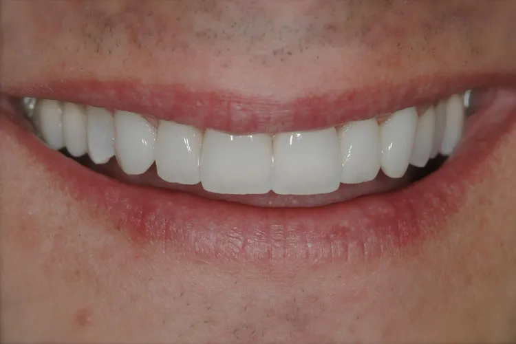 After recomposition of dentures