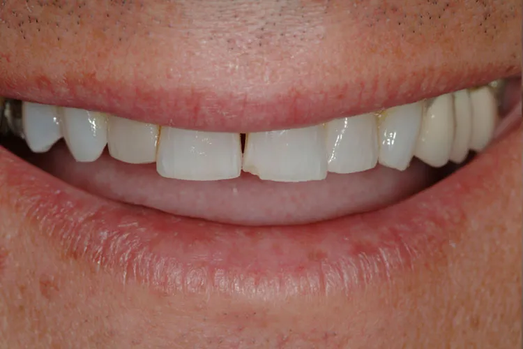 Before recomposition of dentures