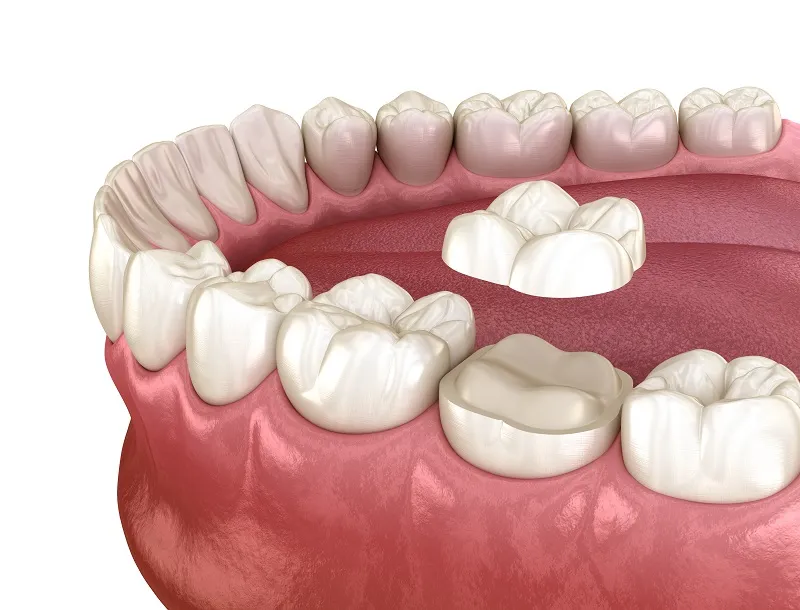 Example of molar crown