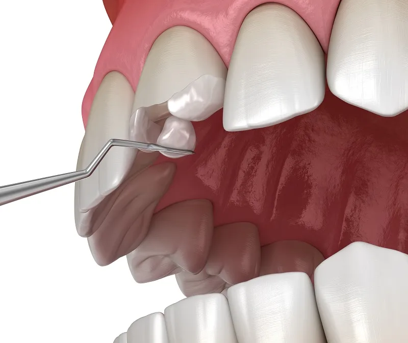 composite fillings for front row teeth