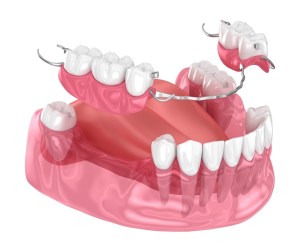 Bottom row denture partial