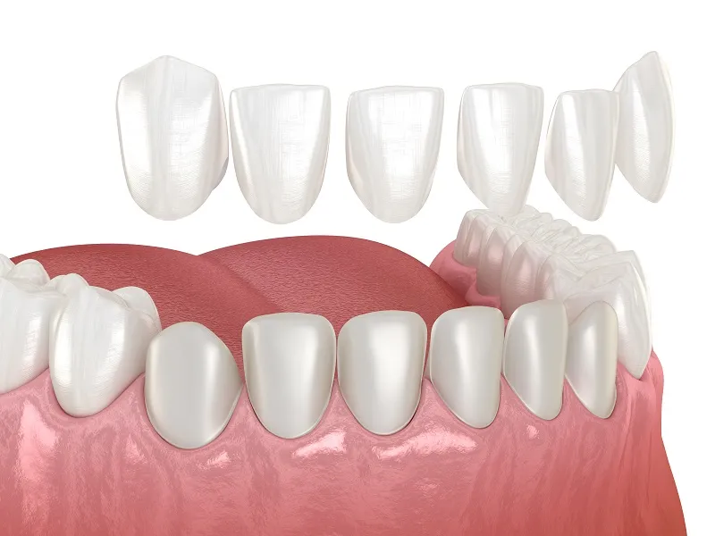animation of bottom row veneers