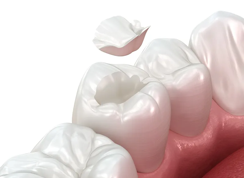 Example of molar crown